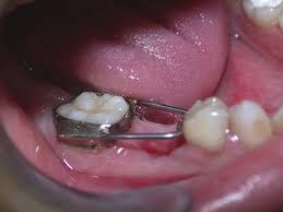orthodontie invisible - Cabinet Dentaire de Vienne - Dr Benjamin Rosenbach