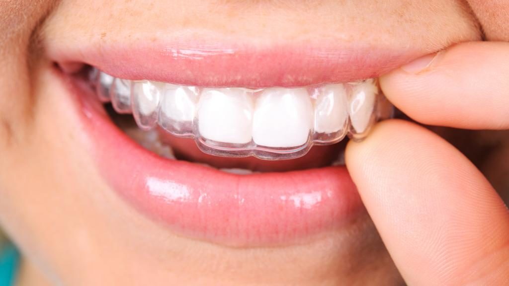 orthodontie invisible - Cabinet Dentaire de Vienne - Dr Benjamin Rosenbach
